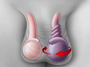 torsión testicular como causa da dor